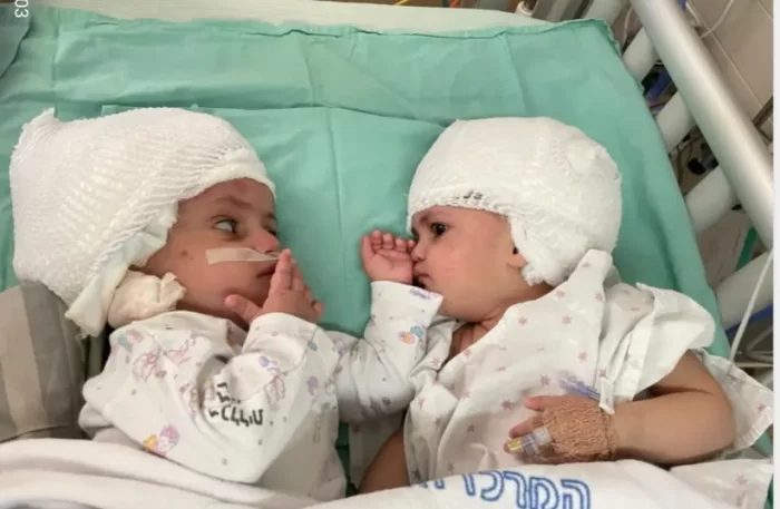 Les jumeaux unis d’un an se sont séparés au centre médical Soroka, en Israël - Photo: avec la permission du Dr Gideon